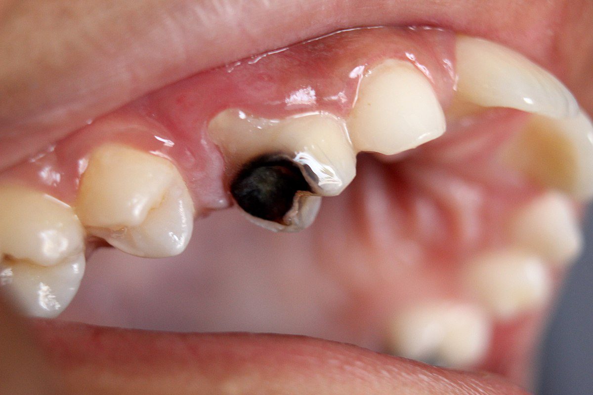How Black Mold Can Cause Tooth Decay - Advanced Periodontics & Implant  Dentistry